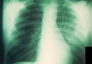 Russian scientist dies in suspected pneumonic plague outbreak in Moscow